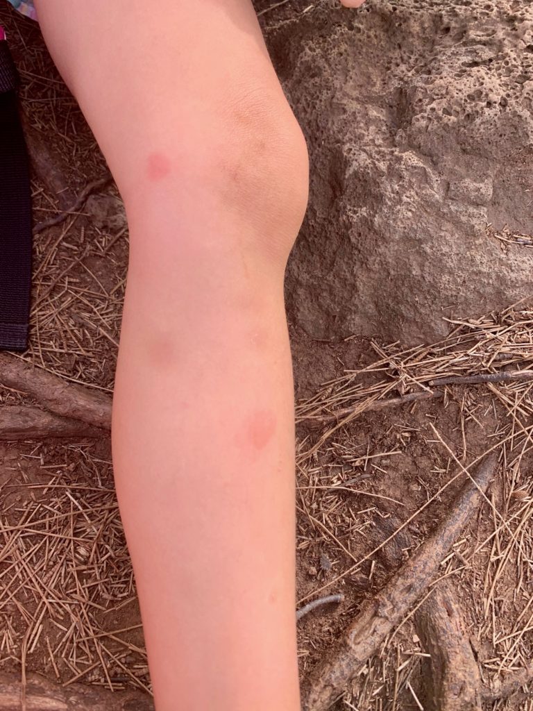 蚊にさされた娘の足